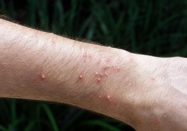 Аллергия на яд насекомых